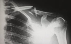 X-ray of person with broken collarbone; image by Harlie Raethel, via Unsplash.com.
