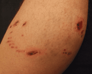 Dog bite on arm; image by Nicor, via Wikimedia Commons, CC BY-SA 3.0, no changes.