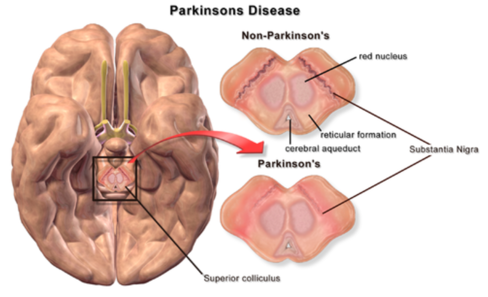 Image by Bruce Blausen. Blausen.com staff (2014). "Medical gallery of Blausen Medical 2014". WikiJournal of Medicine 1 (2). DOI:10.15347/wjm/2014.010. ISSN 2002-4436., CC BY 3.0, via Wikimedia Commons.